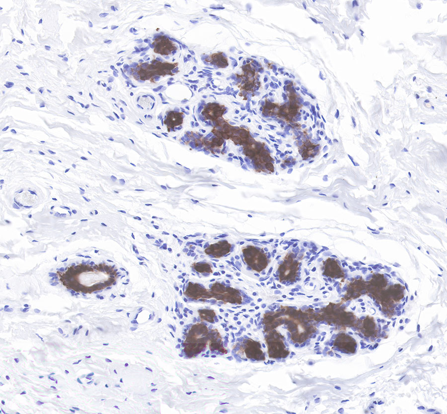 Rabbit anti-CytokeRatin 7 Recombiant Monoclonal Antibody(121-17)