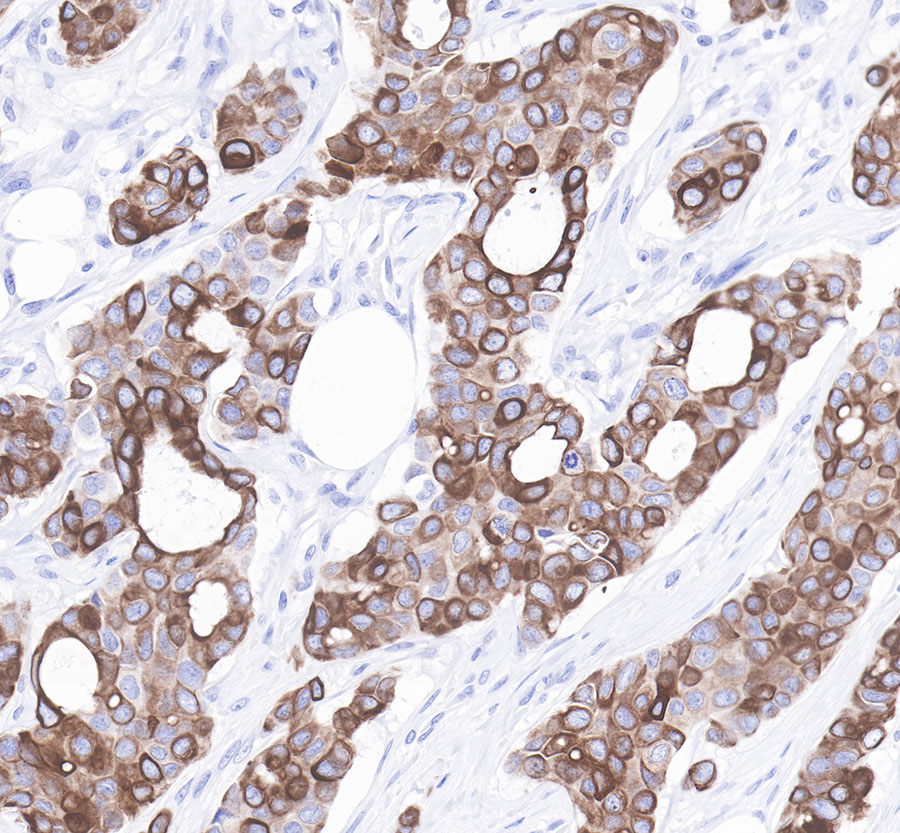 Rabbit anti-CytokeRatin 7 Recombiant Monoclonal Antibody(121-17)