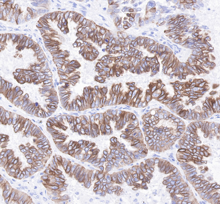 Rabbit anti-CytokeRatin 7 Recombiant Monoclonal Antibody(121-17)