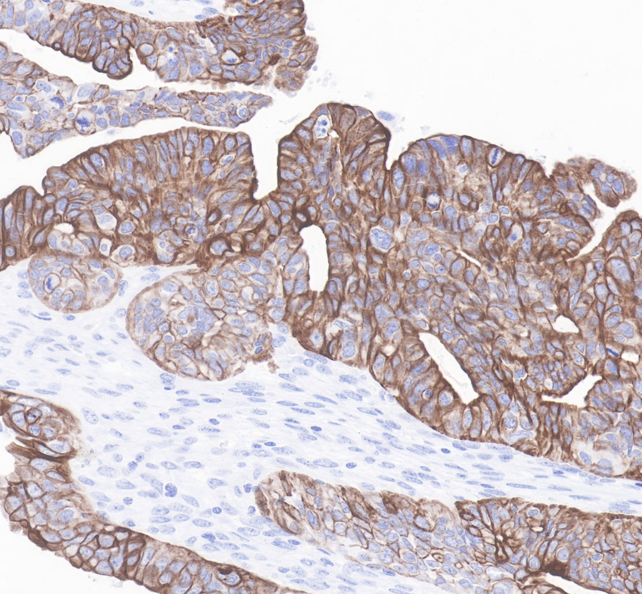 Rabbit anti-CytokeRatin 7 Recombiant Monoclonal Antibody(121-17)