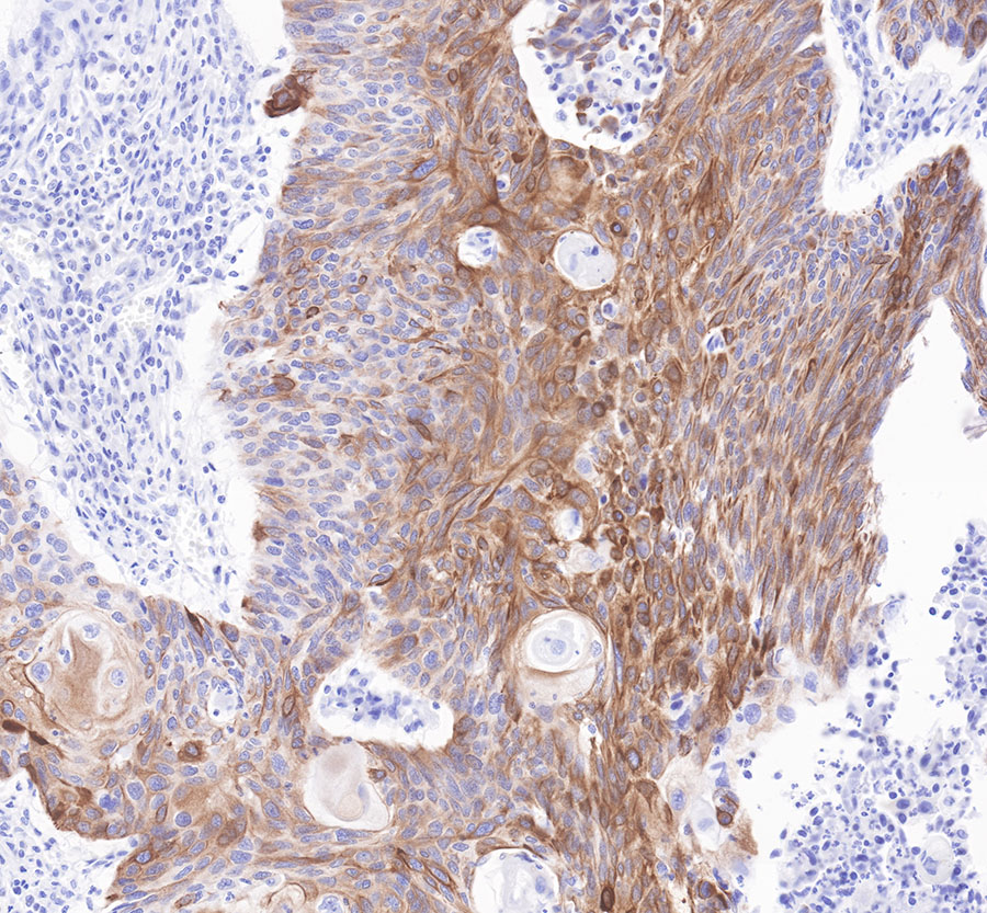 Rabbit anti-CytokeRatin 7 Recombiant Monoclonal Antibody(121-17)