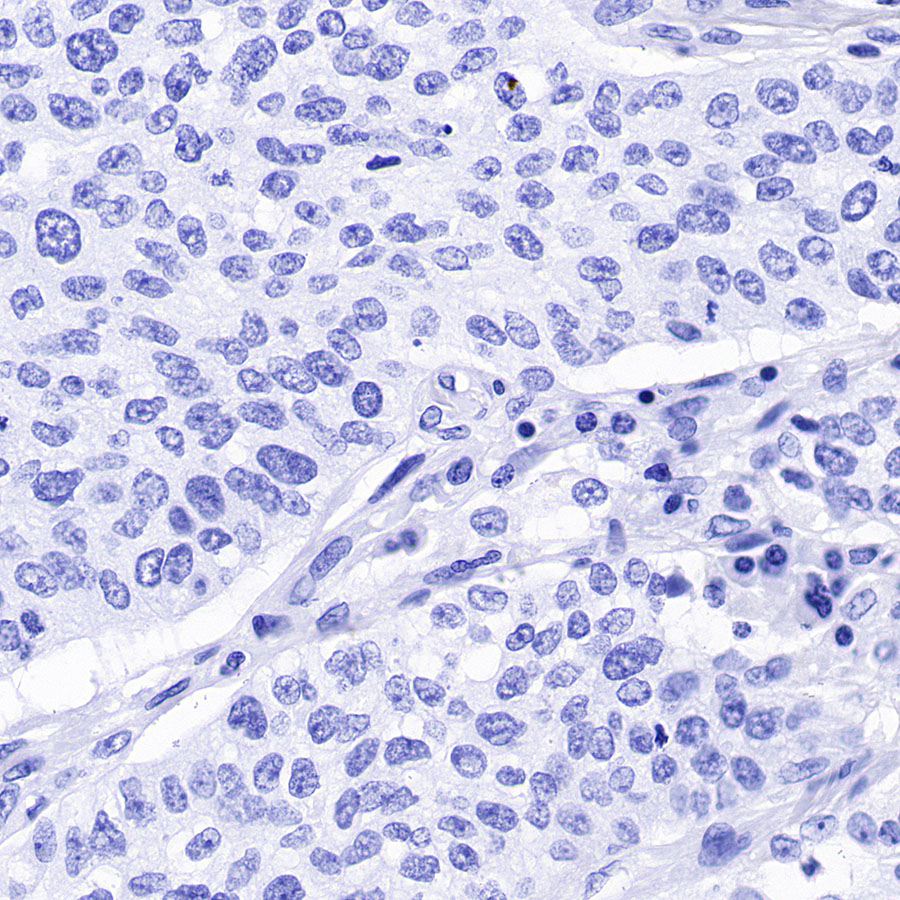 Rabbit anti-CA125 Recombinant Monoclonal Antibody(555-41)